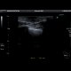Gynecomastia: US - Ultrasound